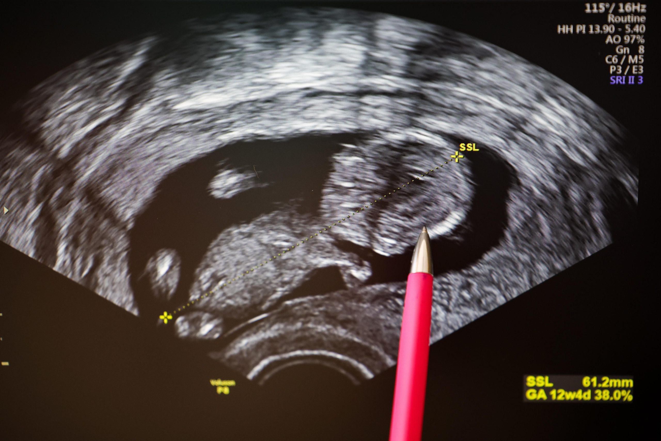A gynecologist points with a pen to the head of a fetus in an ultrasound image.